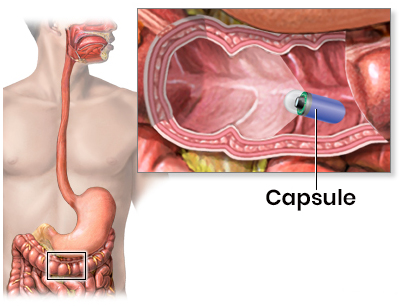 Capsule Endoscopy