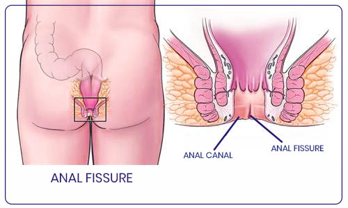 Anal Fissure