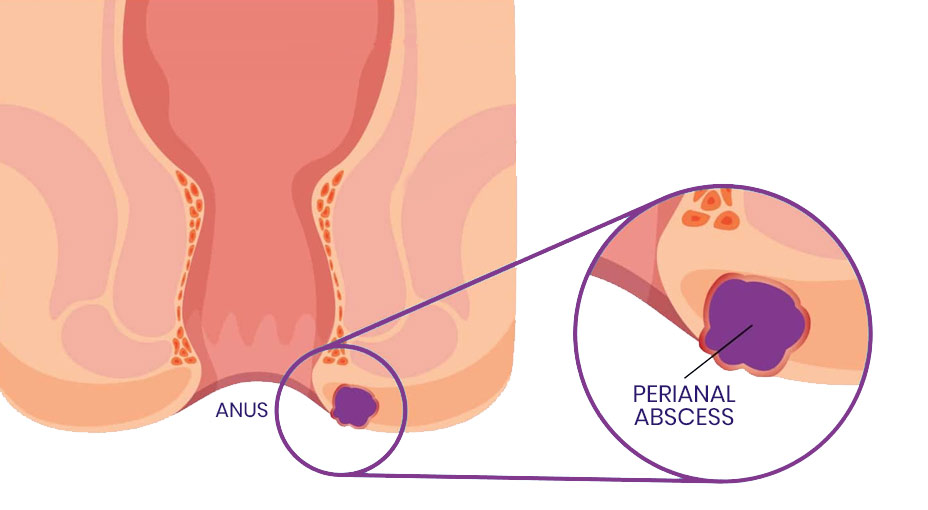 Perianal Abscess & Fistula-in-Ano